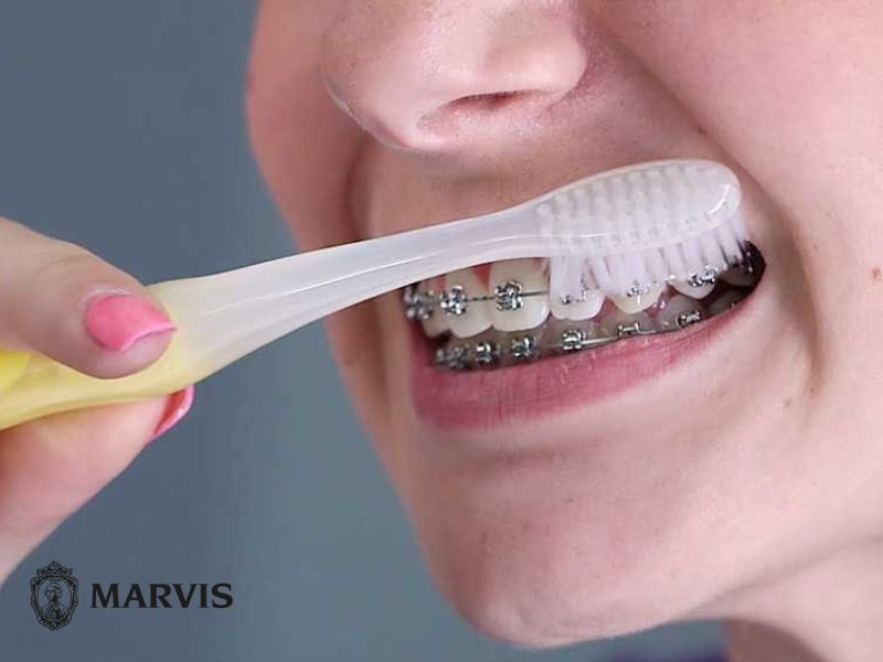 vệ sinh răng miệng khi niềng răng