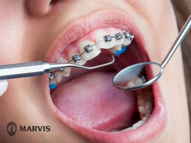 vệ sinh răng miệng khi niềng răng