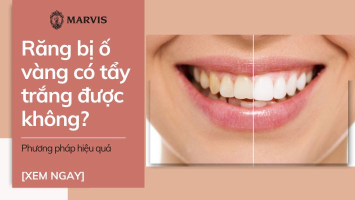 Răng bị ố vàng có tẩy trắng được không