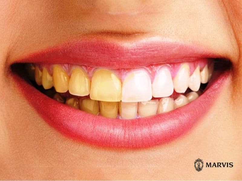 răng bị ố vàng phải làm sao