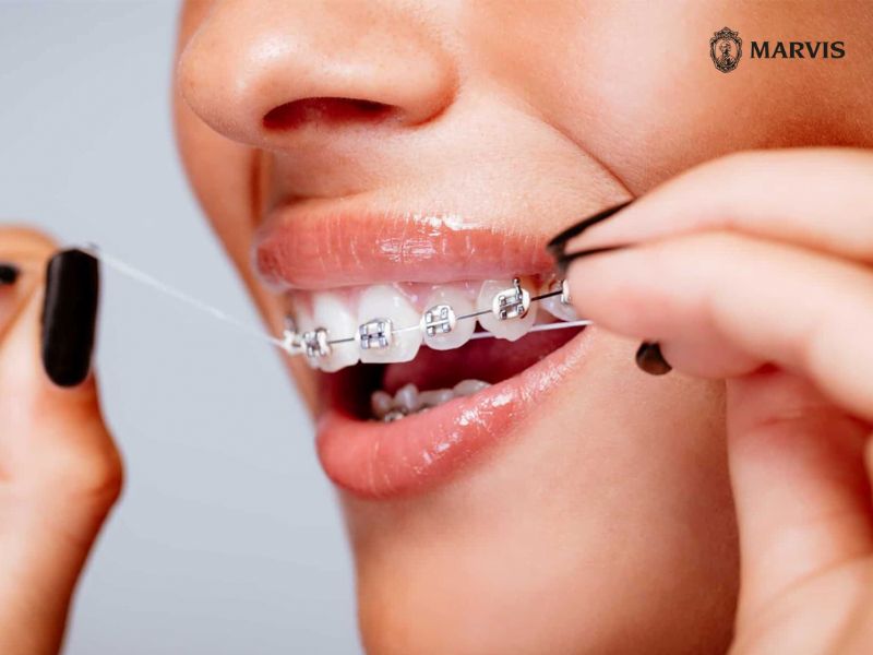 chăm sóc răng miệng khi niềng răng