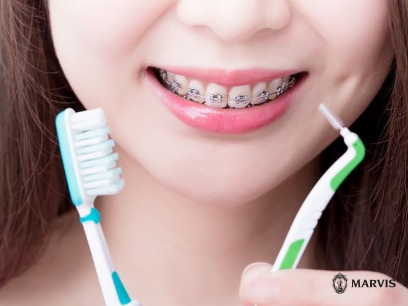 Niềng răng nên đánh răng mấy lần