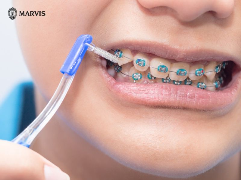 Niềng răng nên đánh răng mấy lần