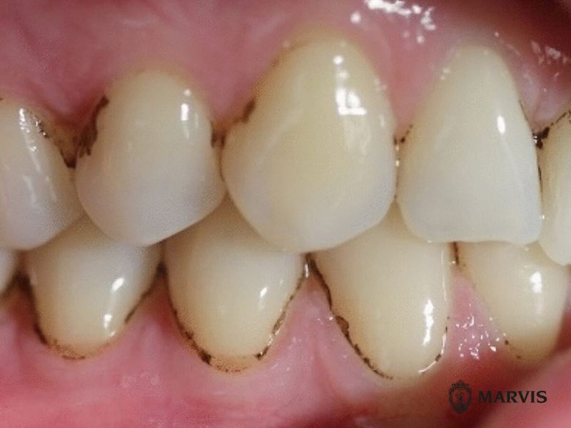 Tại sao răng bị xỉn đen