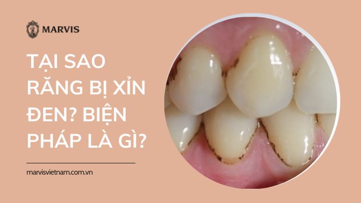 Tại sao răng bị xỉn đen