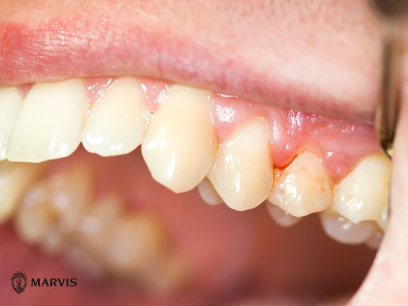 đánh răng bị chảy máu là bị gì