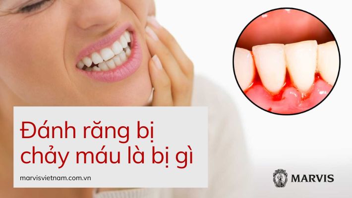 đánh răng bị chảy máu là bị gì