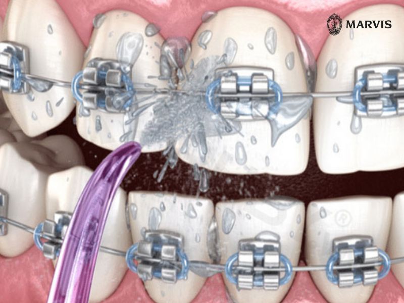 Hướng dẫn chi tiết cách vệ sinh răng niềng bằng tăm nước