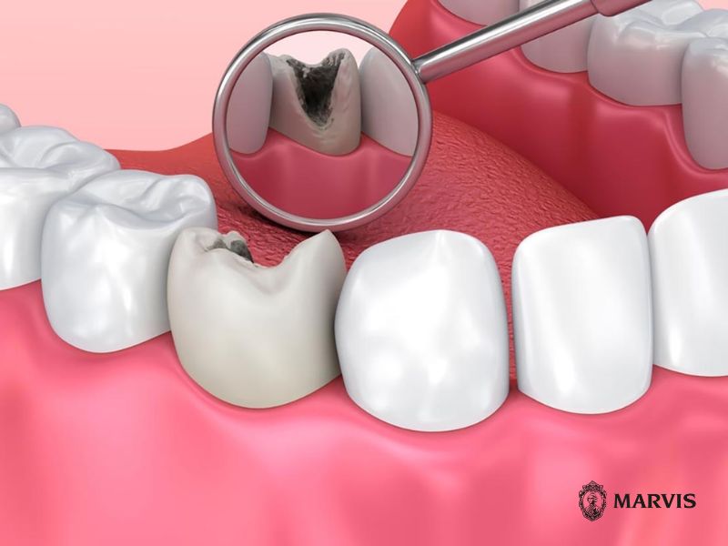 Trị sâu răng vĩnh viễn tại nhà